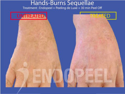 endopeel-post-burns