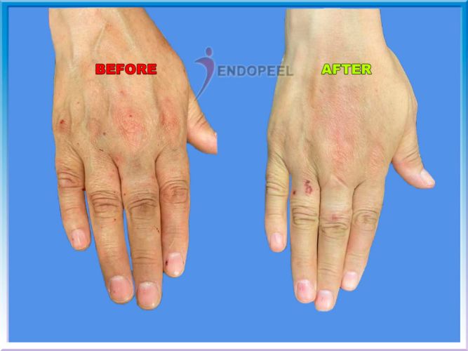 hands-endopeel-naril-sabi