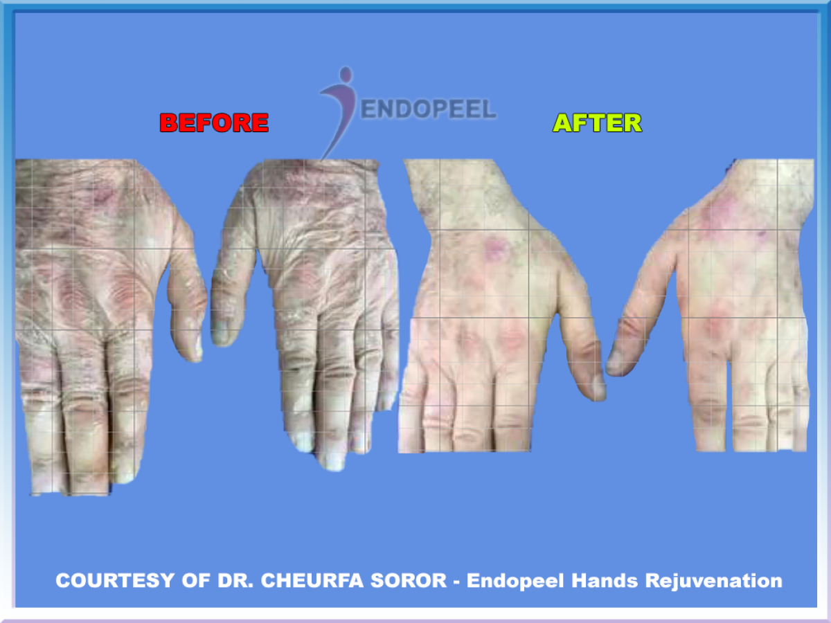 hands endopeel dr cheurfa soror